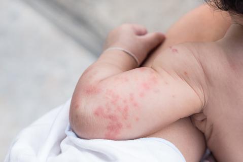 Common baby rashes 01